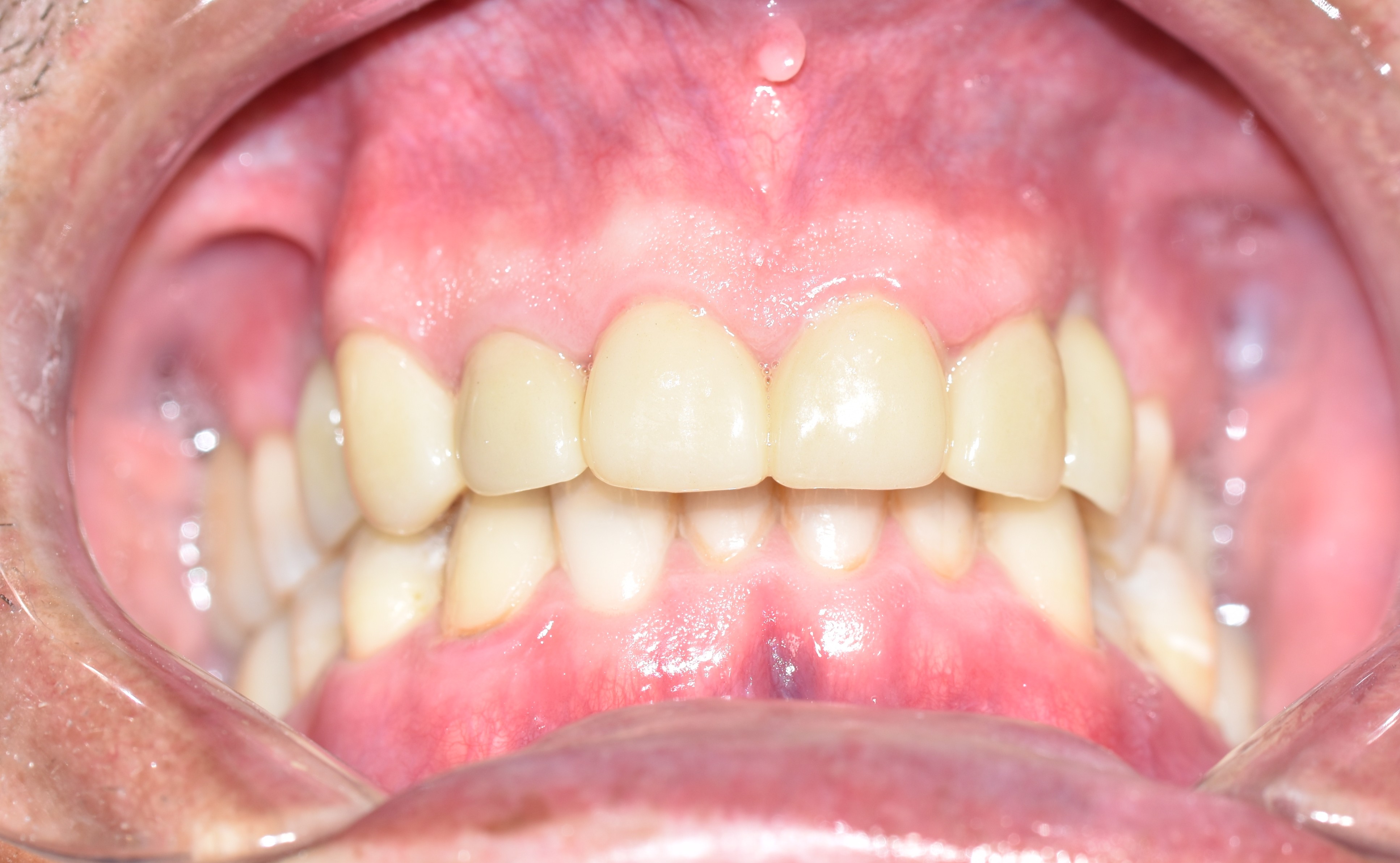 After treatment